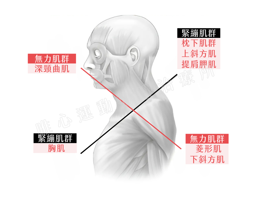 上背痛看哪科？運動後上背痛怎麼辦？教你跟上背痛說掰掰｜桃園物理治療