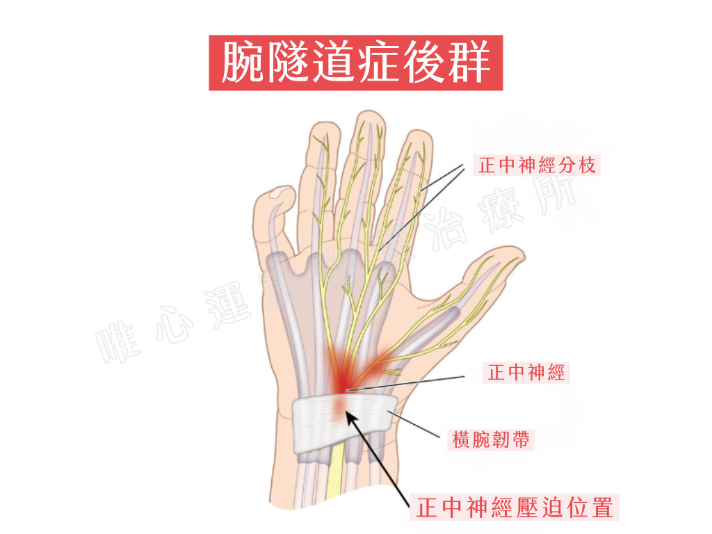 英雄聯盟選手Faker手傷：腕隧道症候群，原因與治療方法｜桃園物理治療