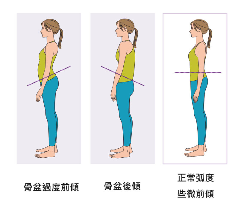 凸小腹不是因為胖，小心是骨盆前傾惹的禍！骨盆前傾症狀與改善｜桃園物理治療