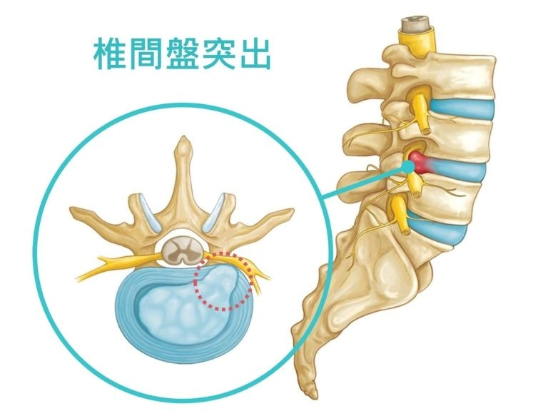 椎間盤突出就像吃漢堡一樣？椎間盤突出症狀與原因，改善就從日常做起｜桃園物理治療