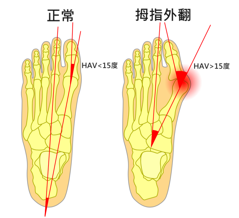 拇指外翻矯正器有用嗎？拇指外翻的症狀與原因，比起治療預防更是關鍵｜桃園物理治療