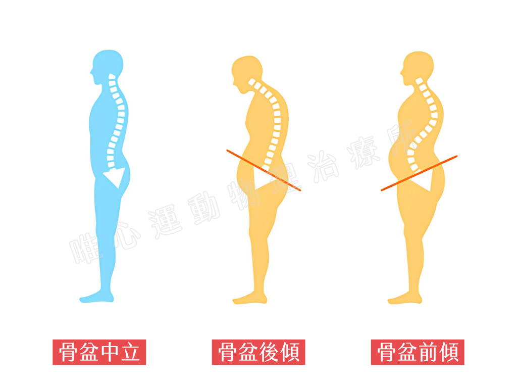 改善長期腰痠背痛，從骨盆後傾矯正開始！一招自我檢測骨盆位置｜桃園物理治療