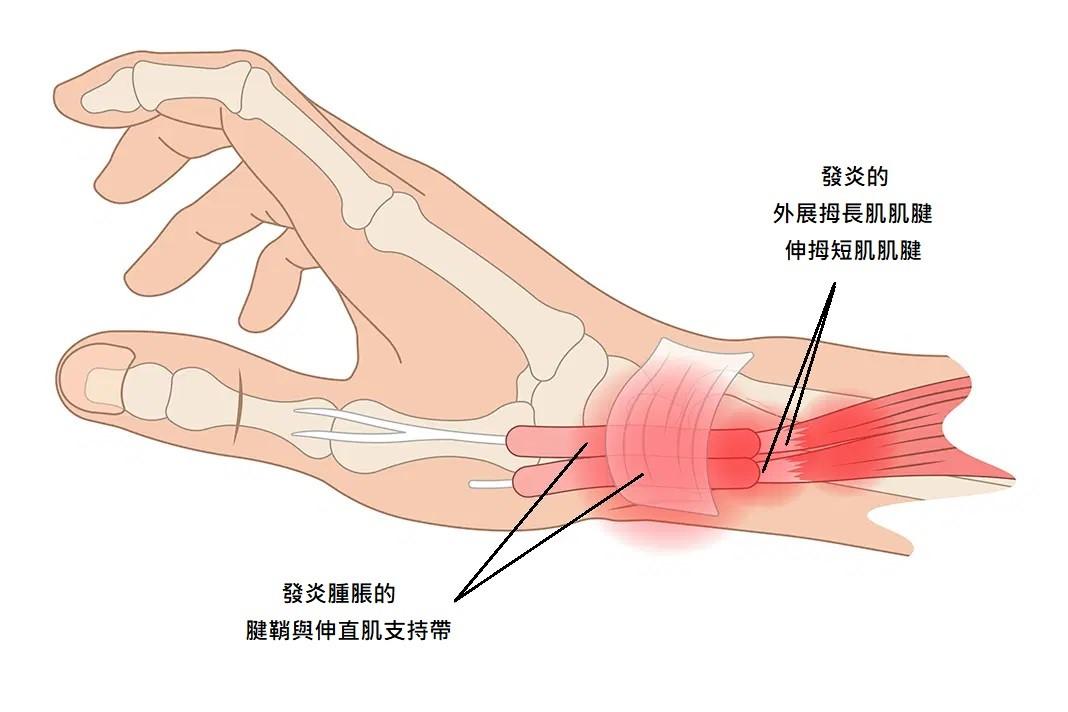 新手父母的手腕痛危機：媽媽手！常見手部疼痛位置與治療方法｜桃園物理治療