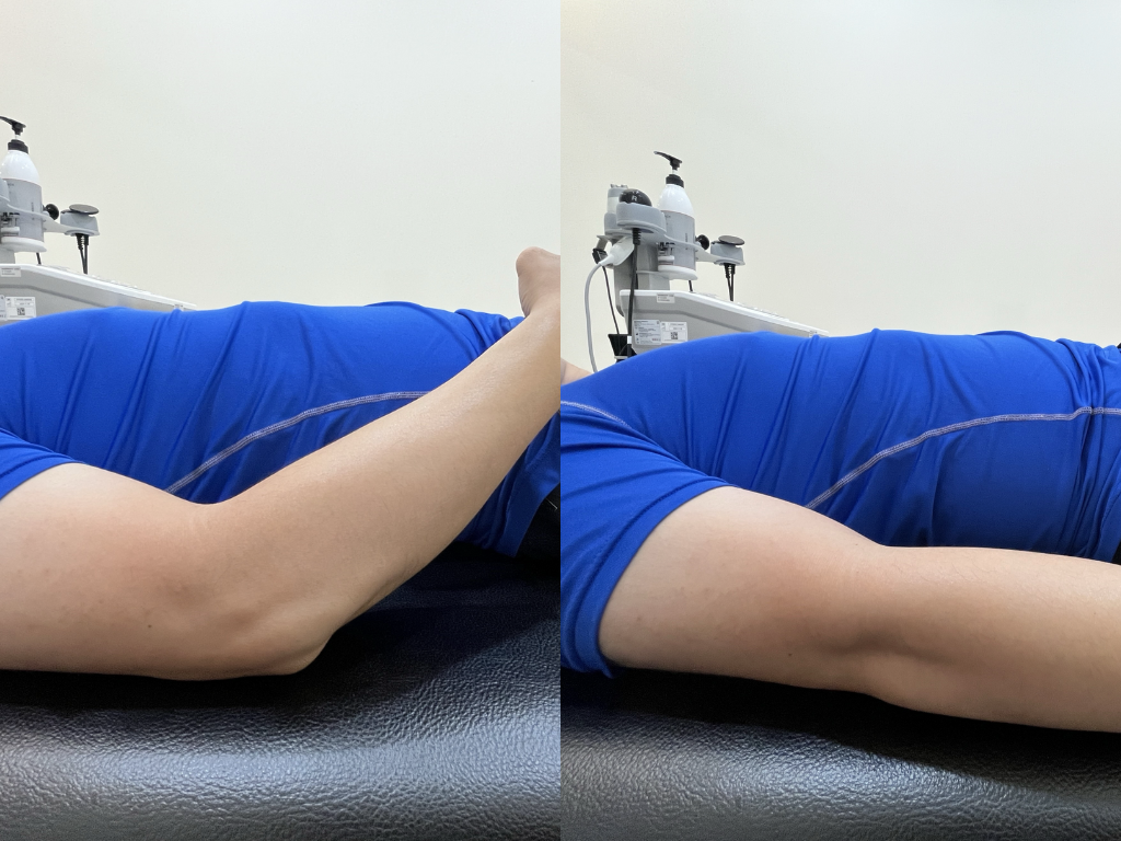 手肘無法伸直的射頻治療過程