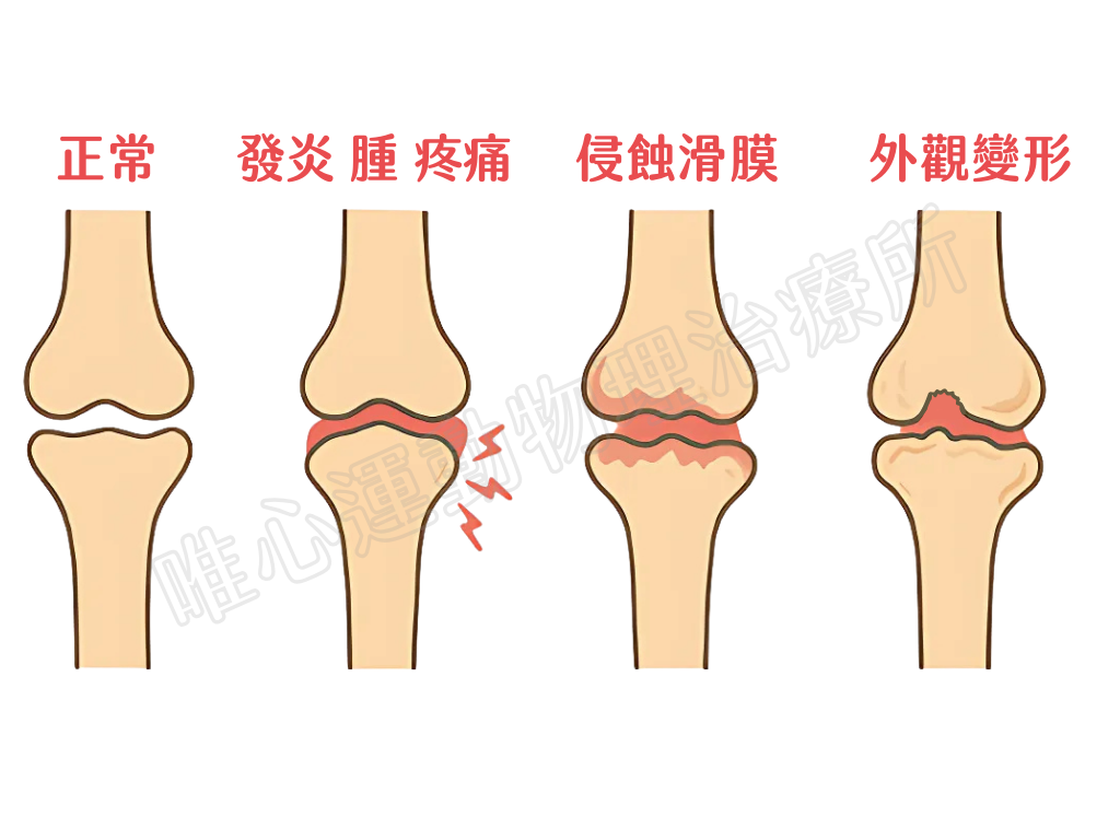 類風濕性關節炎關節變化示意圖