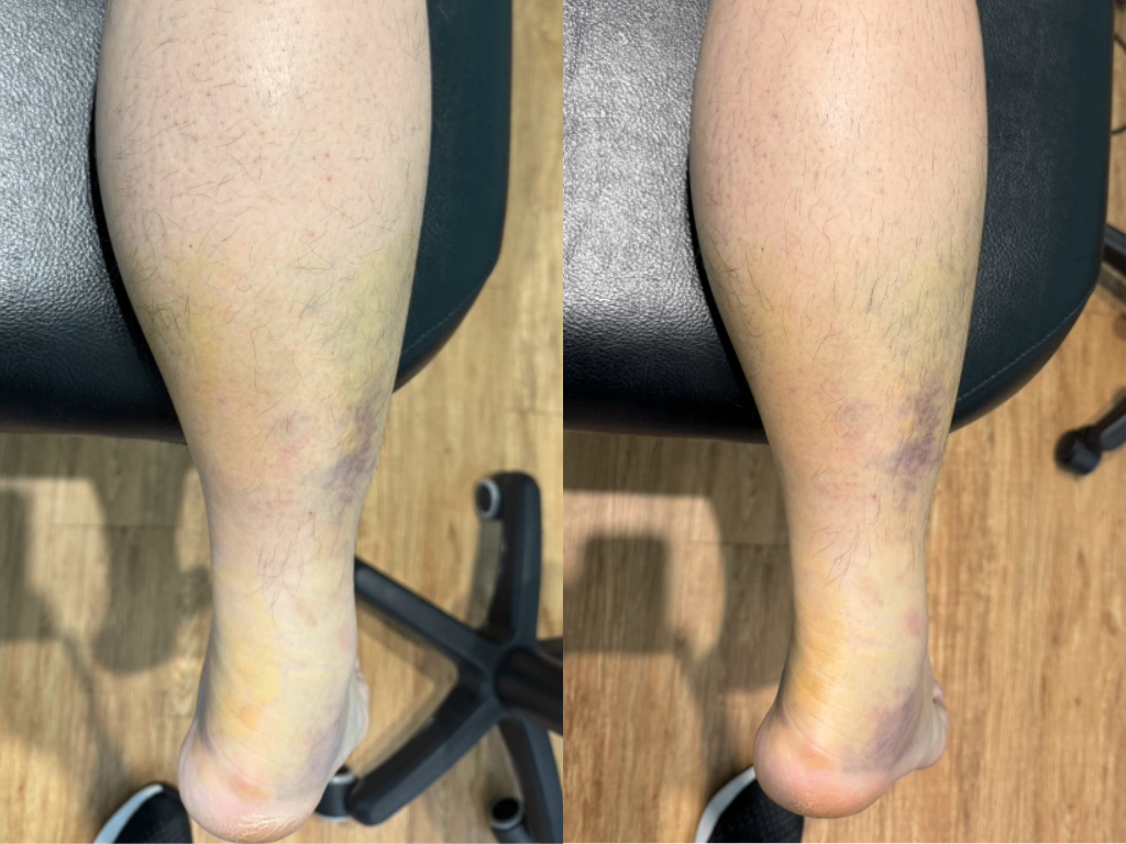 右腳跟腱部分撕裂