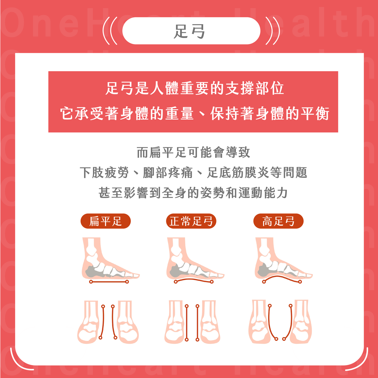 再見扁平足！如何透過足弓鞋墊和物理治療改善足部問題 | 足弓矯正