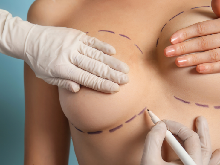 隆乳術後修復三階段指南：消腫期、放鬆期與自然度維持期