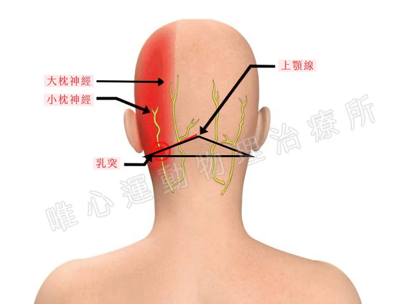 枕神經解剖示意圖：標示枕大神經與枕小神經從頸椎延伸至後腦勺的路徑，說明其受壓迫的原因。