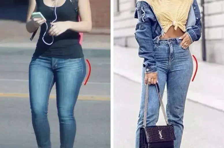 骨盆前傾對外觀的影響：實體呈現假跨寬與凸小腹視覺困擾