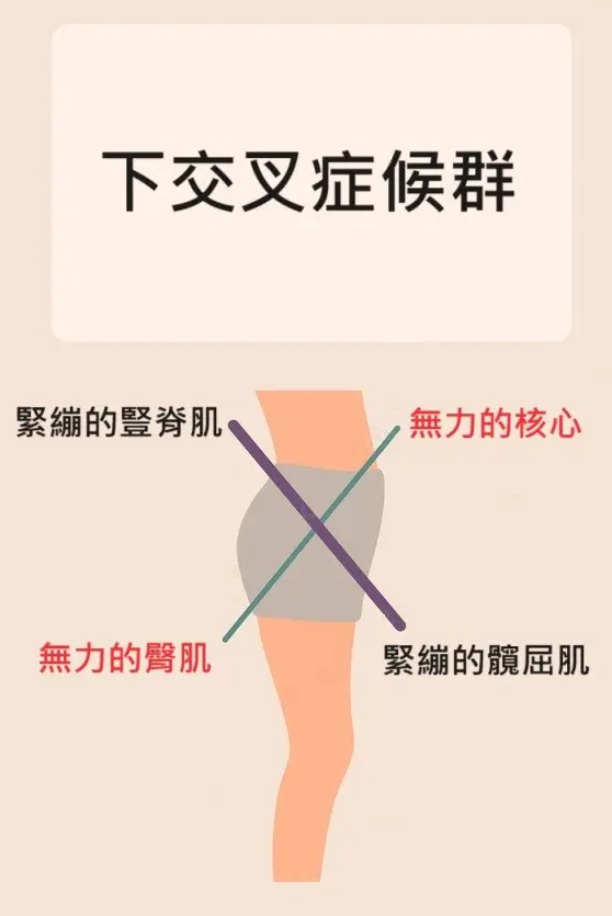 唯心物理治療:骨盆前傾引發下交叉症候群解析,呈現腰椎壓力增加與核心肌群失能的內部機制