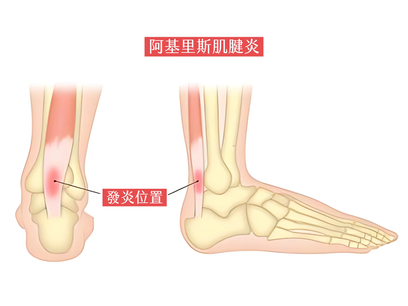 唯心運動醫療體系物理治療師指出啦啦隊常見運動傷害包含阿基里斯腱發炎
