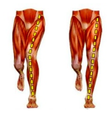 唯心運動醫療體系圖解：跑步或下蹲時膝蓋內扣（Valgus）容易引發ITBS